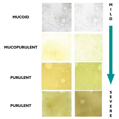 Copd Sputum Colour Chart