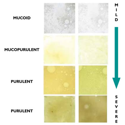 different colors of sputum