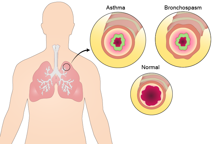 body_lungs_asthma